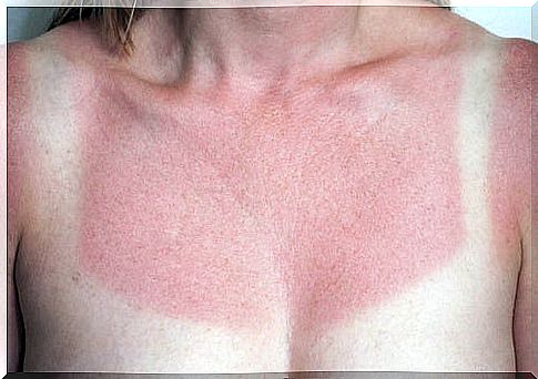 5 Home Remedies to Relieve Sunburn Immediately