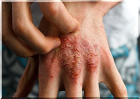 psoriatic arthritis itches