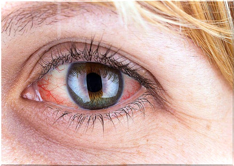 Conjunctivitis