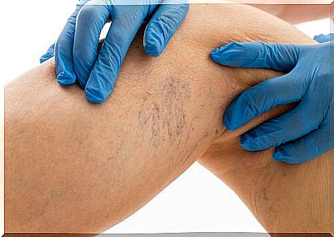 8 rules to follow if you want to cure varicose veins