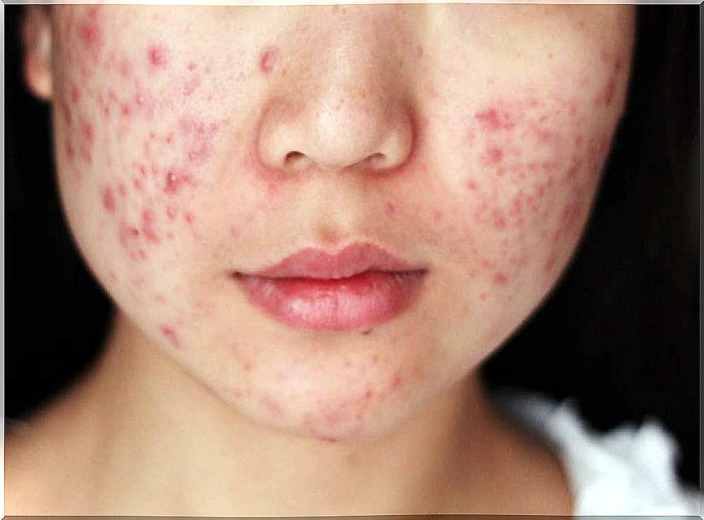 person with acne