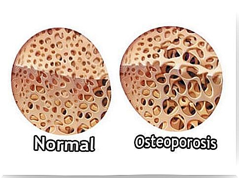 Osteoporosis_-500x350