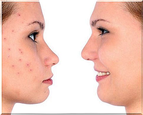 water with apple cider vinegar to get rid of acne