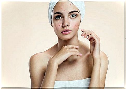 How to eliminate acne