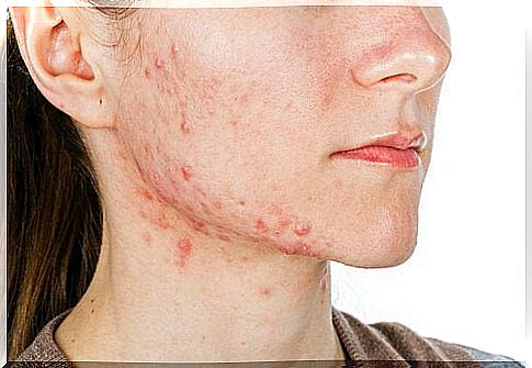 Internal treatments for acne