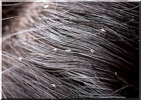 Dandruff can be a health problem