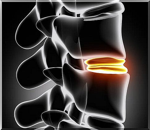 hernia-of-disk