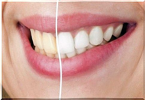 How to whiten teeth naturally?