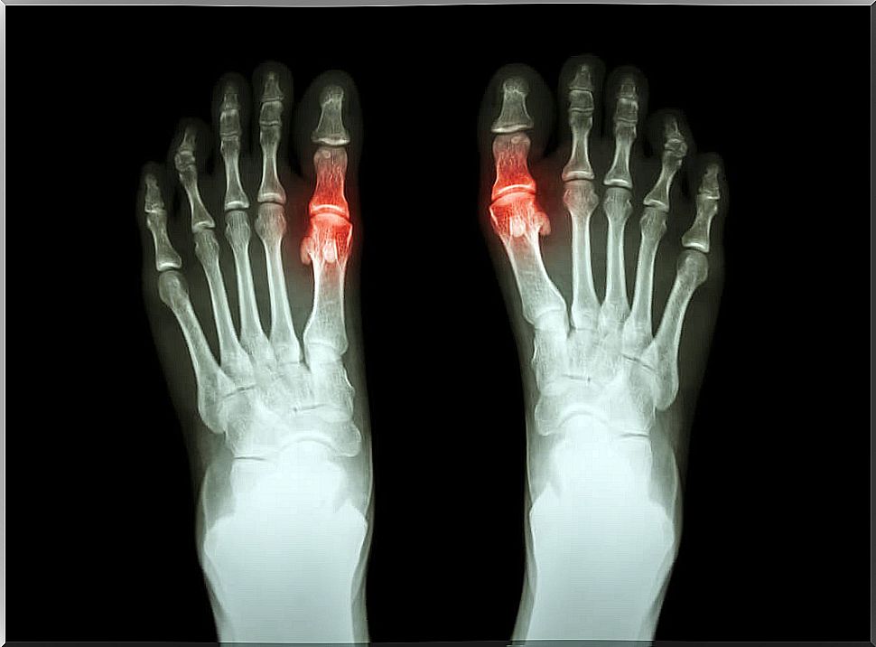 Natural and Effective Remedies to Treat Gout Symptoms