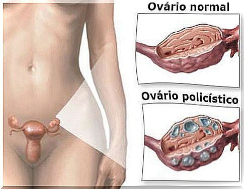 Natural Treatment for Polycystic Ovary Syndrome