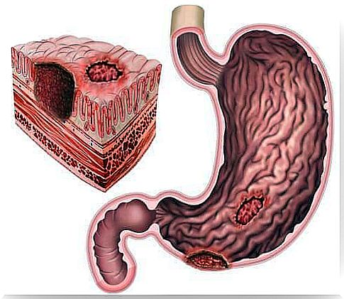 Peptic ulcers and Helicobacter pylori