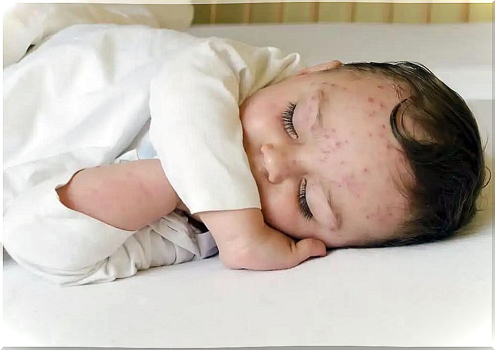 baby with chickenpox